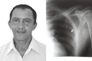 Ex-vereador de Duque Bacelar/MA fica com bala alojada no tórax, após reagir a assalto