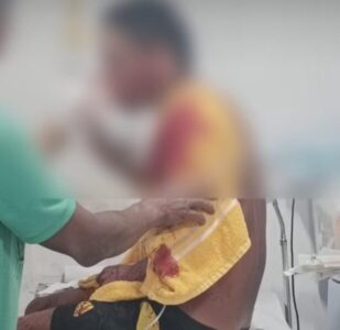 Jovem, de 22 Anos, sobrevive a tiro que desviou do nariz para a orelha em Imperatriz