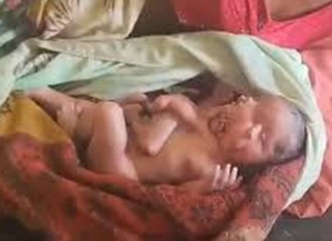 Bizarro!!! Bebê Nasce Com Quatro Pernas, Quatro Braços E Dois Rostos, Mas Não Sobrevive