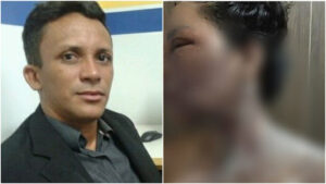 Marido é acusado de jogar água quente em vereadora do Maranhão