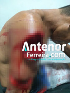 Homem tem braço quase decepado durante briga no interior de Belágua/MA