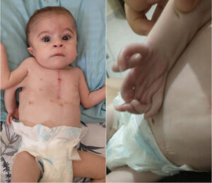 Bebê com 3 braços e metade do coração intriga médicos em São Paulo