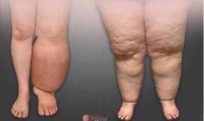Lipedema: conheça as atualizações globais sobre os tratamentos da doença