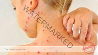 OMS alerta para aumento de casos de sarampo e reforça vacinação