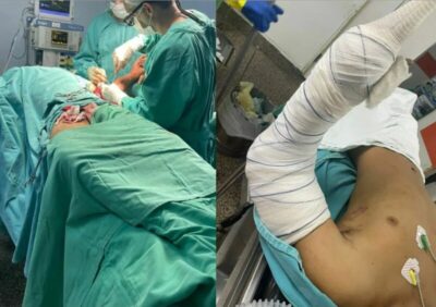 Médicos do Socorrão I realizam reimplante de braço em paciente