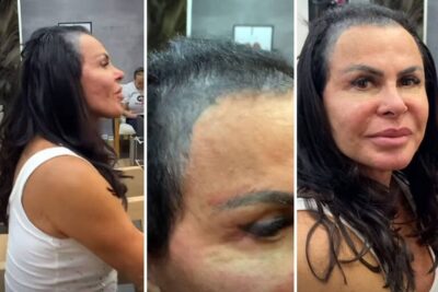 Gretchen mostra calvície. Entenda como o transplante capilar pode ajudar a artista