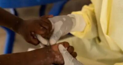 Ministério da Saúde confirma primeiro caso de nova cepa de mpox no Brasil