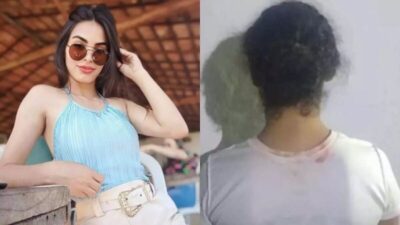 Jovem atacada com ácido apresenta melhora mas segue internada na UTI