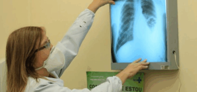 Maranhão registrou quase 13 mil casos de tuberculose em 5 anos