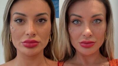 Andressa Urach reclama da mudança de cor de olho: “Não vale a pena a dor”