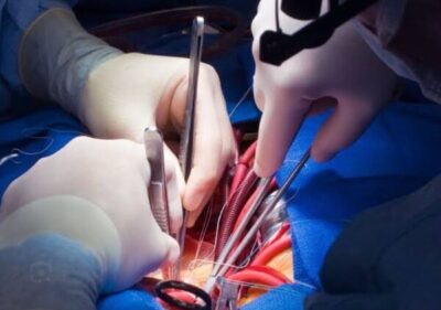 Ex-secretário municipal de Timon passa por cirurgias de angioplastia coronárias e diz: “Nasci de novo”