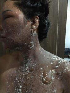 COVARDIA: No Maranhão, ex-vereador joga água quente no rosto da própria esposa