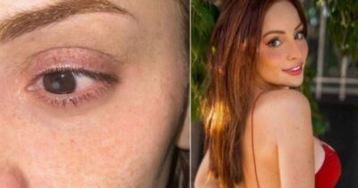 Influenciadora perde a visão após contrair parasita carnívoro na córnea