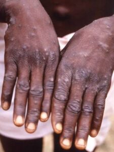 SECRETARIA DE SAÚDE DESCARTA CASO DE VARÍOLA DO MACACO EM SÃO LUÍS