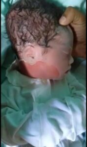 Mais um bebê nasce morto e com a cabeça toda machucada no Hospital Materno Infantil em Barra do Corda