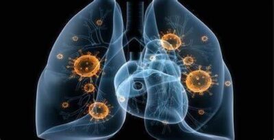 Maranhão registrou 2.953 casos de tuberculose em 2024
