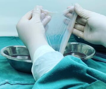 Membrana de placenta poderá ser usada pelo SUS no tratamento de queimaduras graves