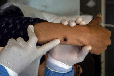 Ministério da Saúde confirma primeiro caso da nova cepa de Mpox no Brasil
