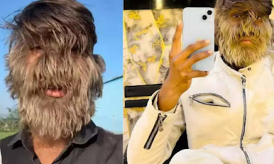 Adolescente Entra Para O Guinness Por Rosto Mais Peludo Do Mundo