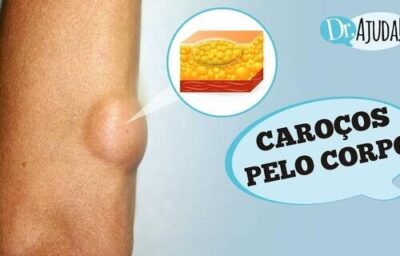 Caroços pelo corpo e lipoma: O que são? O que reparar?