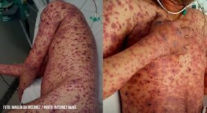 Alerta de saúde sobre aumento de casos de mpox no Pará e reforço nos cuidados.