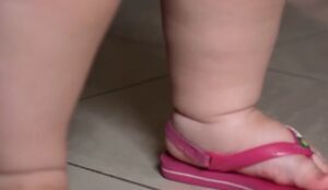 Maranhão registra mais de 24 mil crianças diagnosticadas com obesidade em 2024