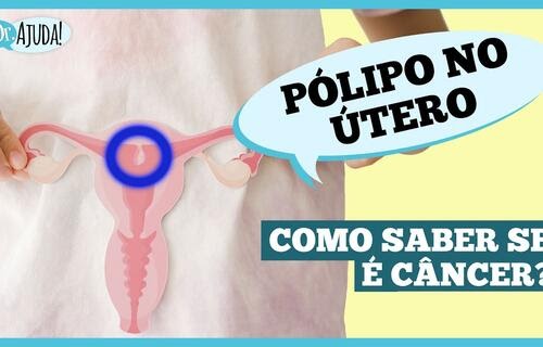 O que são pólipos uterino e quais os sintomas?