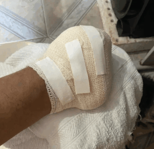 Carteiro com pé amputado após contrair bactéria agoniza em São Luís por incompetência do INSS
