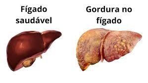Gordura no fígado: veja os alimentos que ajudam e os que devem ser evitados