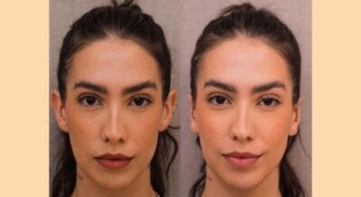 Otomodelação: A Nova Febre Entre as Celebridades que Querem Orelhas Perfeitas