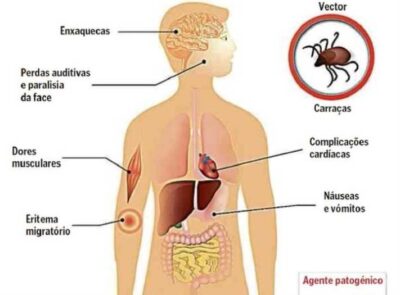 DOENÇA DE  LYME: Dor generalizada, febre e desmaios: campanha alerta para doença bacteriana misteriosa