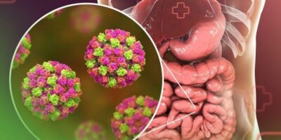 Norovírus provoca gastroenterite e é resistente ao álcool em gel