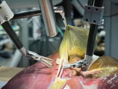 Histórico: robô com IA faz 1ª cirurgia em órgão humano sem ajuda de médicos