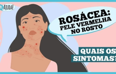 Rosácea: o que é e quais são os sintomas