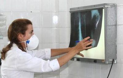 Tuberculose: Amazonas lidera incidência no Brasil, seguido por Roraima e Rio de Janeiro