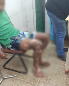 Vazamento de gás em restaurante deixa cinco pessoas feridas em Olho d’Água das Cunhãs