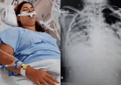 Enfermeira maranhense alerta sobre riscos do cigarro eletrônico após enfrentar pneumonia grave