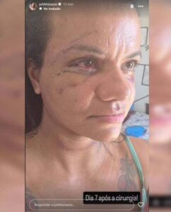 Juliana Garcia, usou suas redes sociais para mostrar como está seu processo de recuperação