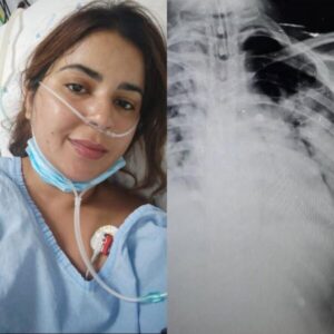 Enfermeira de São Luís alerta sobre riscos do cigarro eletrônico após enfrentar pneumonia grave
