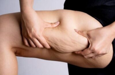 Lipedema: por que tantas mulheres ainda sofrem anos sem diagnóstico?