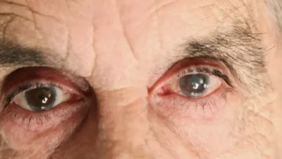 Prefeitura de Cururupu realiza na próxima segunda-feira (24), mutirão de consulta de Glaucoma