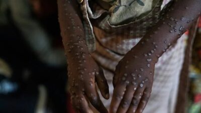 OMS retira status de emergência internacional da mpox após queda de casos e mortes