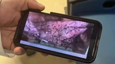 Lutador de 20 anos posta foto de pulmão destruído pelo cigarro eletrônico