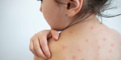 Casos de sarampo tiveram aumento de 34 vezes em 2025, alerta Opas