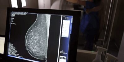 Ministério da Saúde passa a recomendar mamografia a partir dos 40 anos
