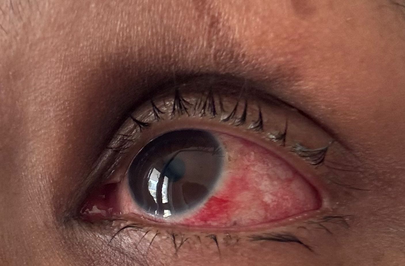 Especialistas da rede pública do Distrito Federal destacam a importância de atenção aos cuidados com a conjuntivite.