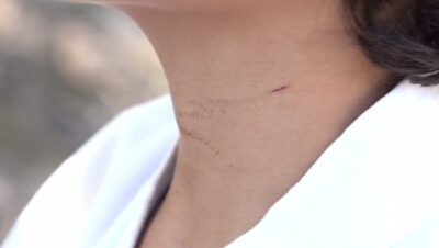 Criança é ferida por linha de kitesurf em praia de São Luís