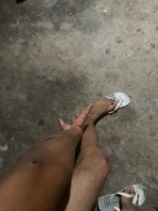 Motociclista fica ferido após colidir em obra não sinalizada da Qualitech