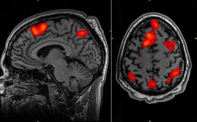 Cientistas conseguem avanço inédito em tratamento de doença degenerativa com terapia genética