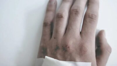 MPOX: DE UGANDA À EUROPA NOVA CEPA JÁ CIRCULA EM SEIS PAISES FORA DA ÁFRICA